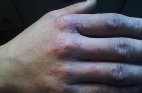 手指湿疹用什么药膏