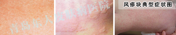 风疹块的症状有哪些_荨麻疹图片_青岛皮肤病研究院