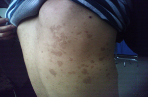花斑糠疹的常见原因有哪些