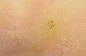 病毒性皮肤病 疣   目前来说,传统治疗寻常疣的方法很多:采用激光仪