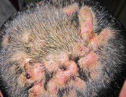 掘性头部毛囊周围炎病因:本疾病是一种少见的头顶部慢性化脓性皮肤病