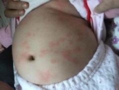 小儿荨麻疹怎么治 日常护理很重要 