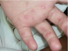秋季荨麻疹怎么护理 
