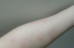 预防秋季荨麻疹要注意哪些 